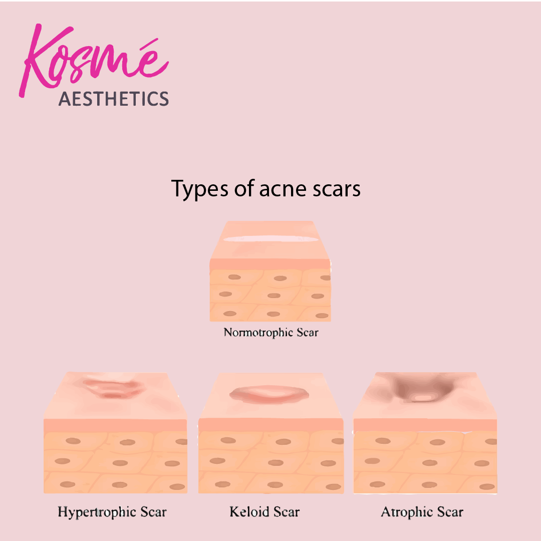 Types of acne scars: hypertrophic scars, keloid scars, atrophic acne scars, normotrophic scars