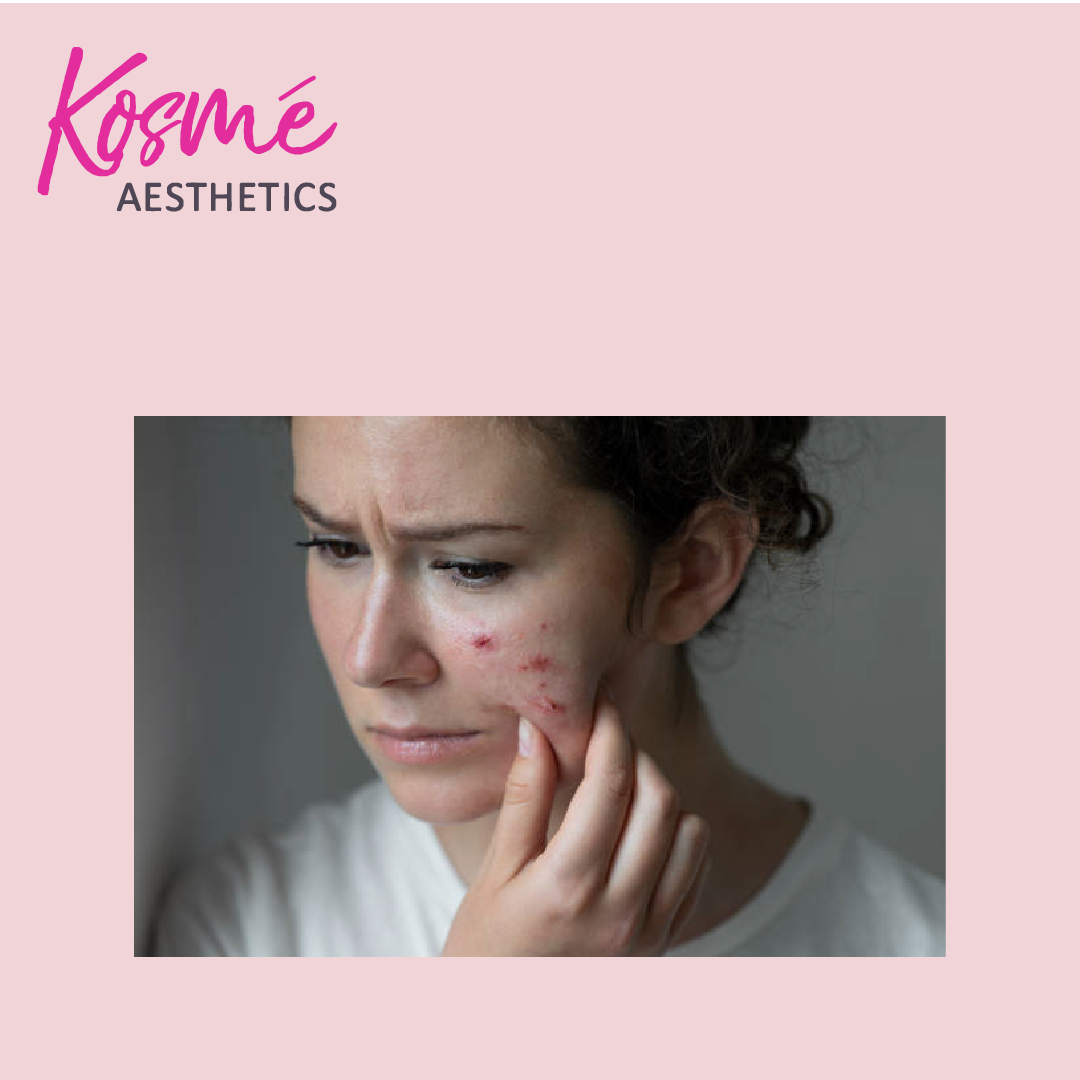 skin surface,depressed scars,ice pick scars ,acne marks