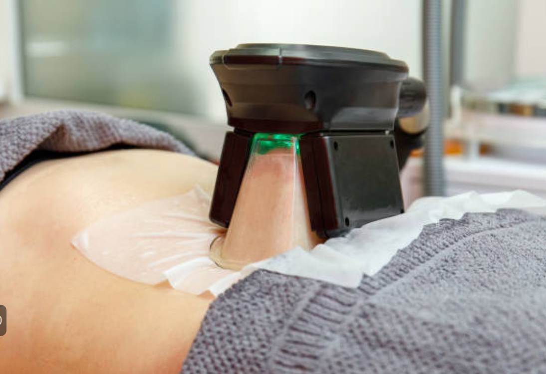 Fat Freeze Treatment sessions
