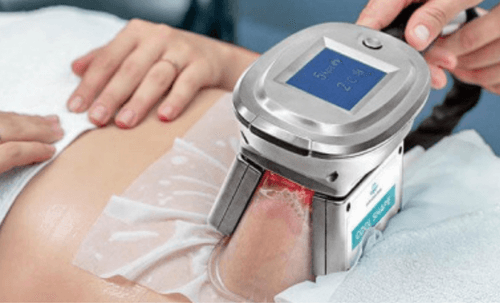 Fat Freeze is non-invasive