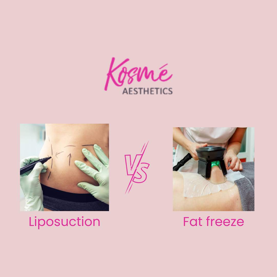Liposuction vs fat freeze which is cheaper