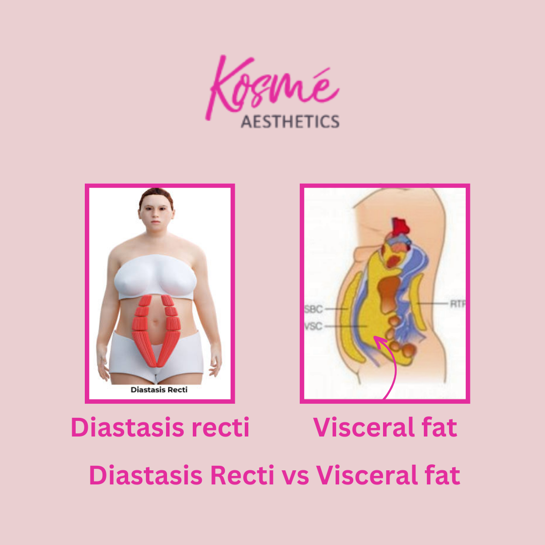 Diatasis recti vs visceral fat