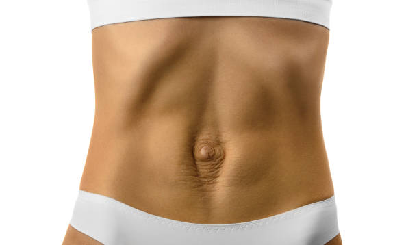 Diastasis recti in women