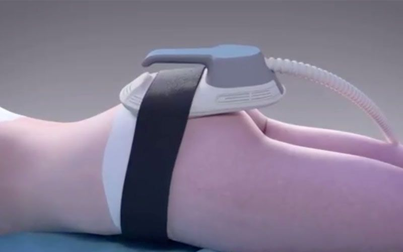 buttock lift using EMS