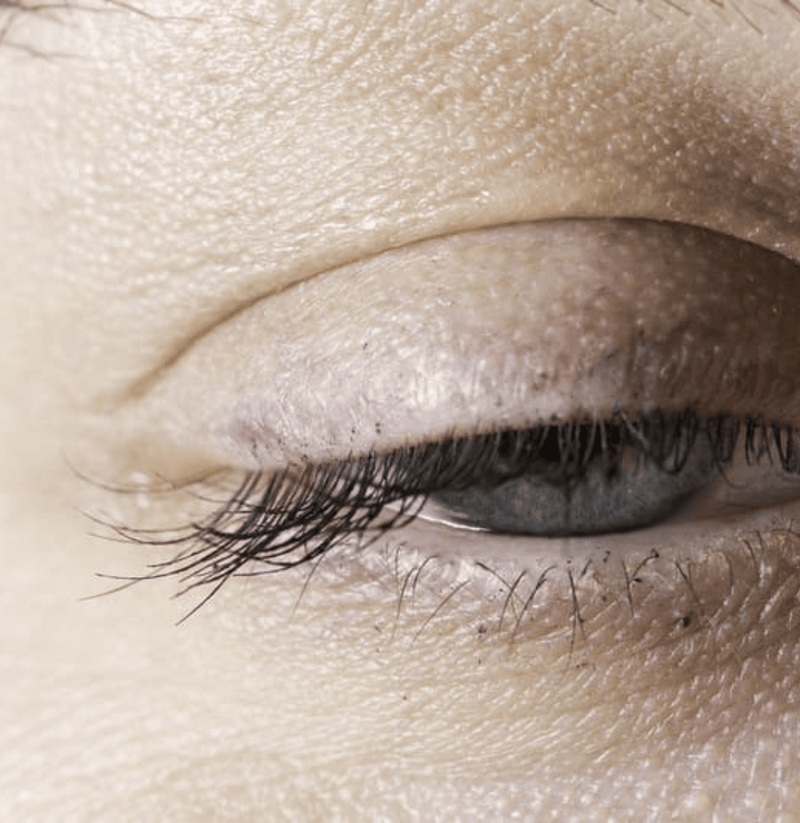 When Is Eyelid Surgery Covered By OHIP 