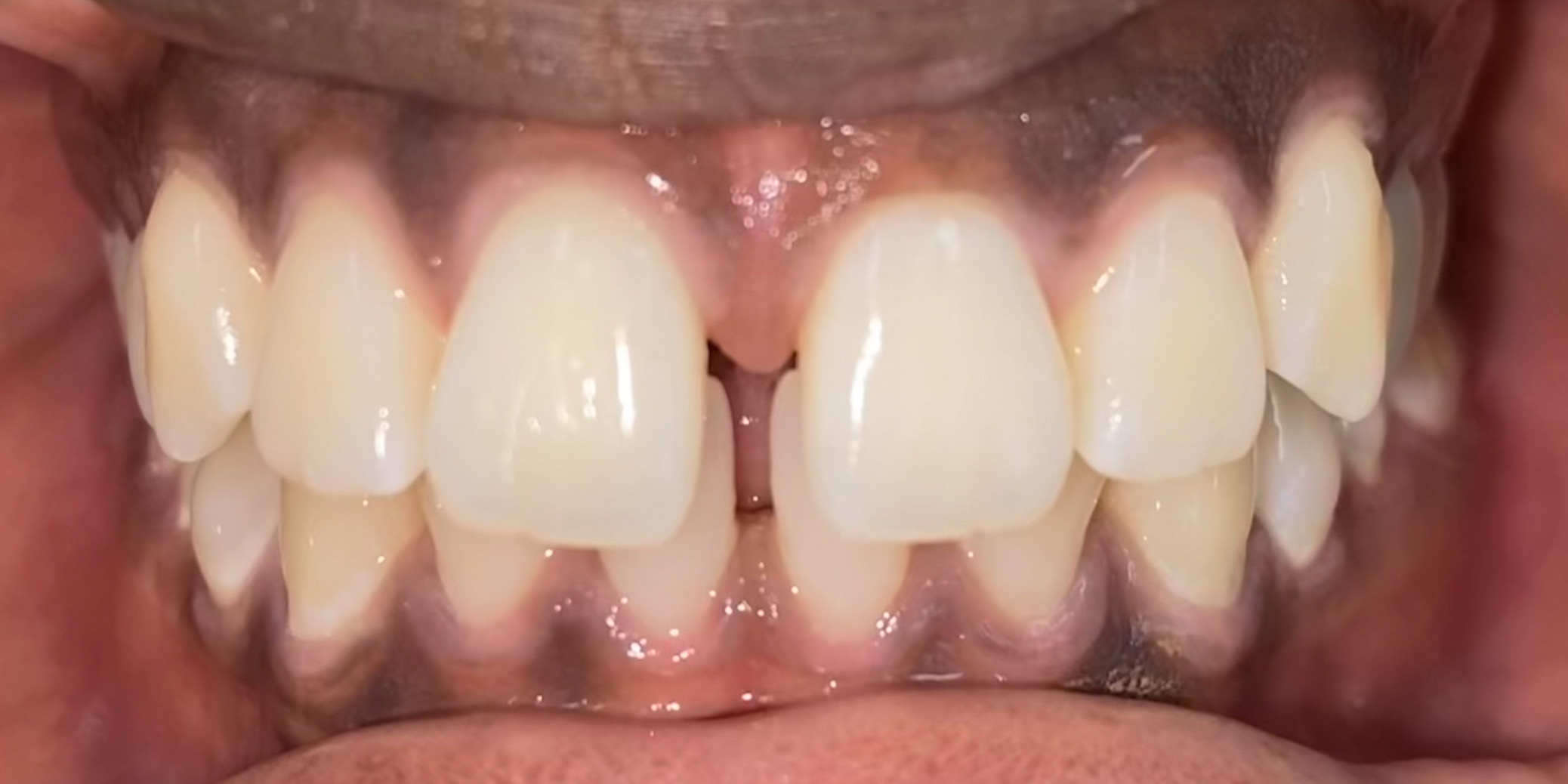 Aligneurs Transparent — Clinique Dentaire Bellechasse