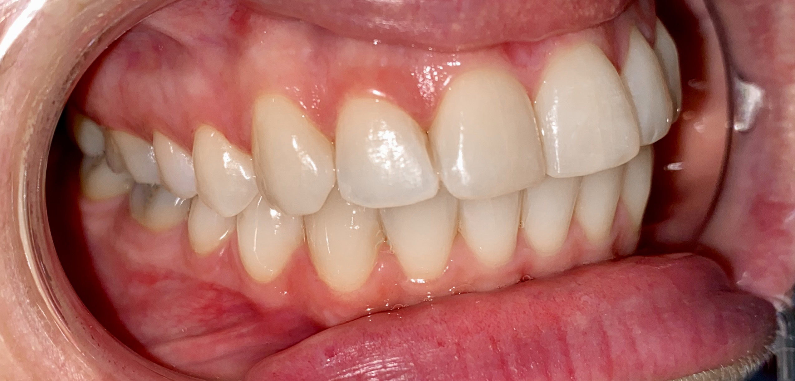 Aligneurs Transparent — Clinique Dentaire Bellechasse