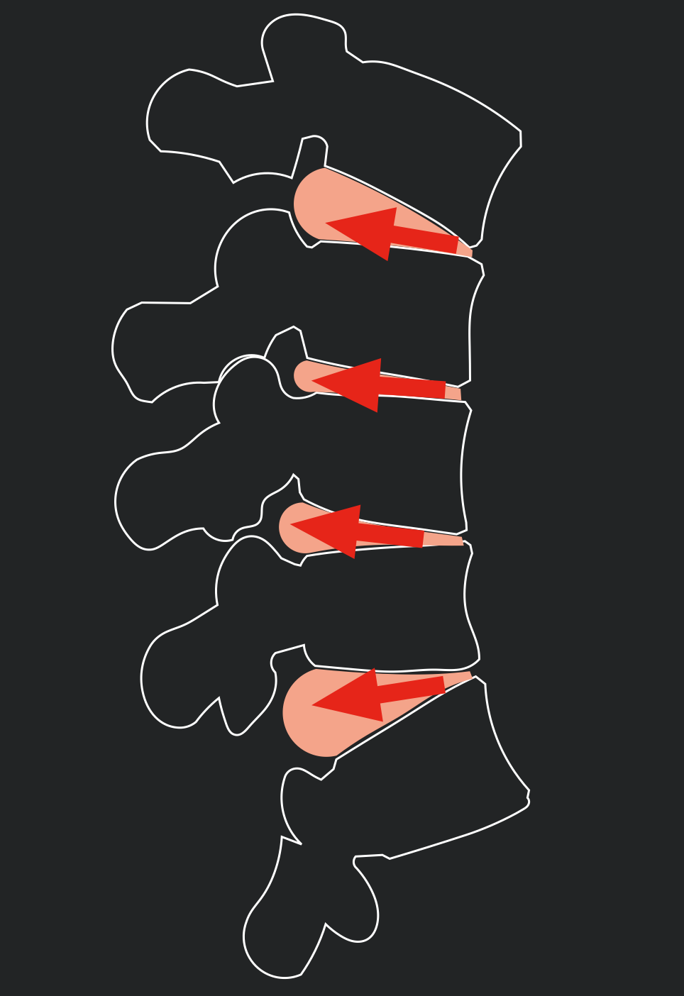 Biomechanics of the spine posture, forces and structures Core Advantage