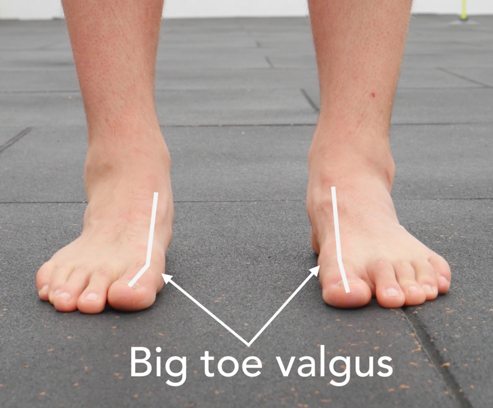 Running Program for Transitioning to Barefoot Shoes (Minimalist/Zero