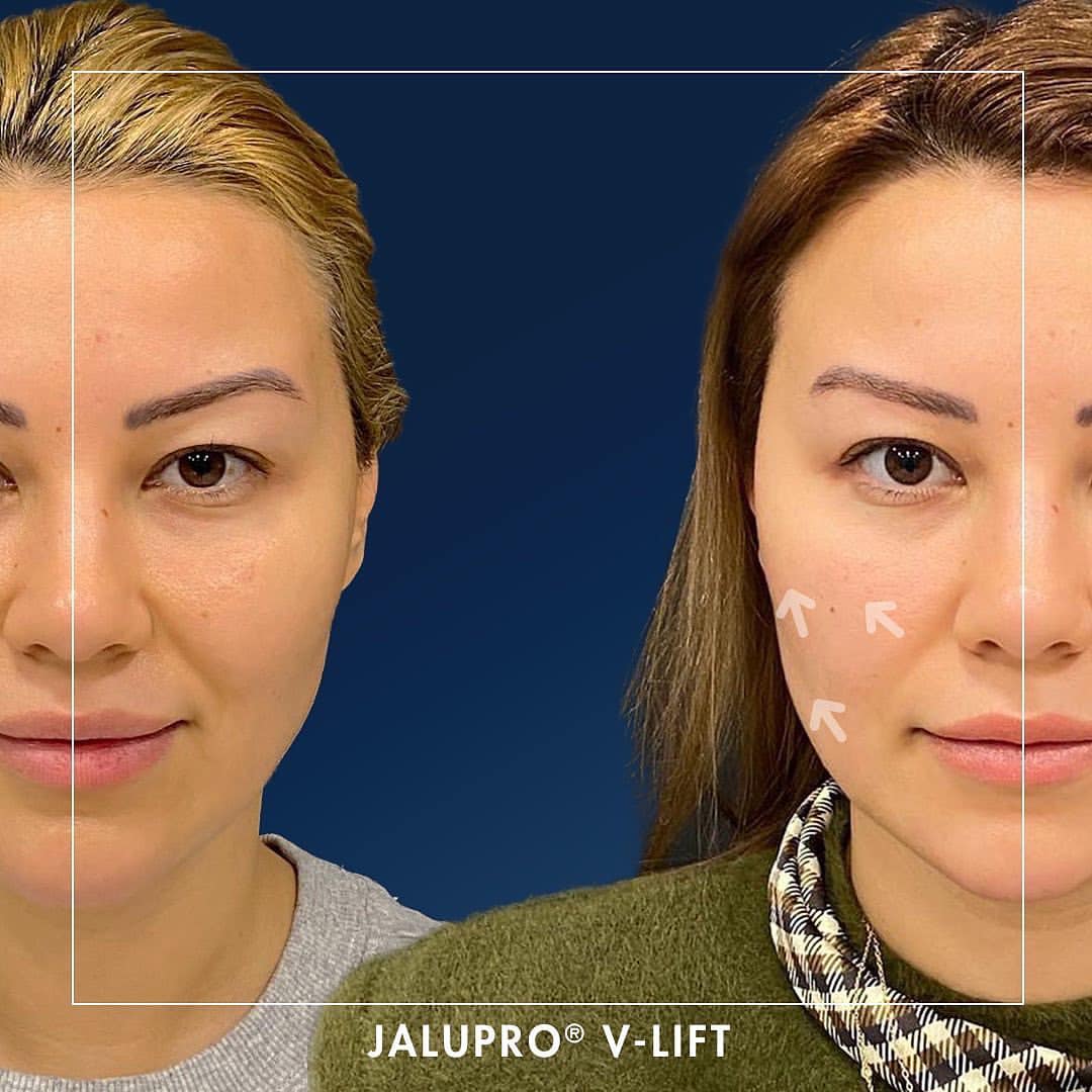 Jalupro Super Hydro Nâng cơ và trẻ hoá rõ rệt chỉ sau 2 tuần Julapro Việt Nam