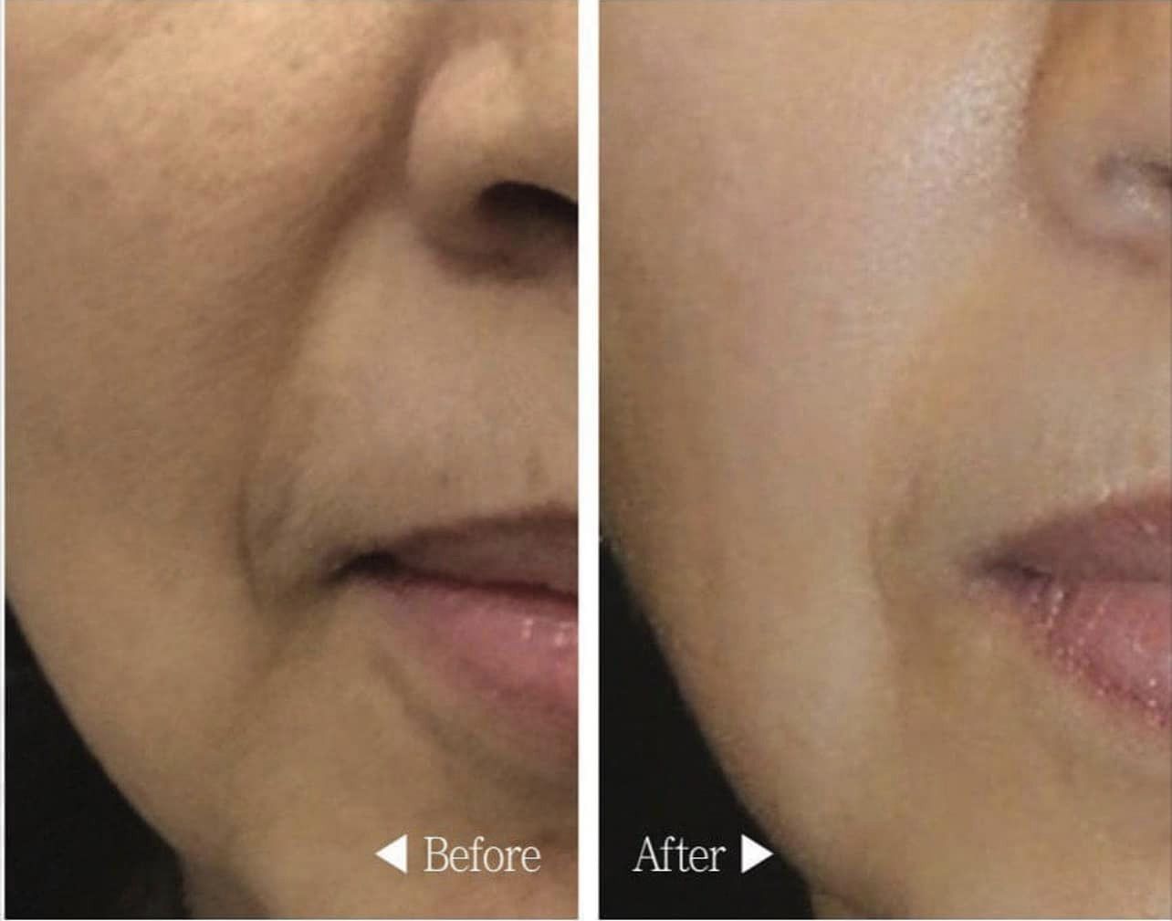 Jalupro Super Hydro Nâng cơ và trẻ hoá rõ rệt chỉ sau 2 tuần