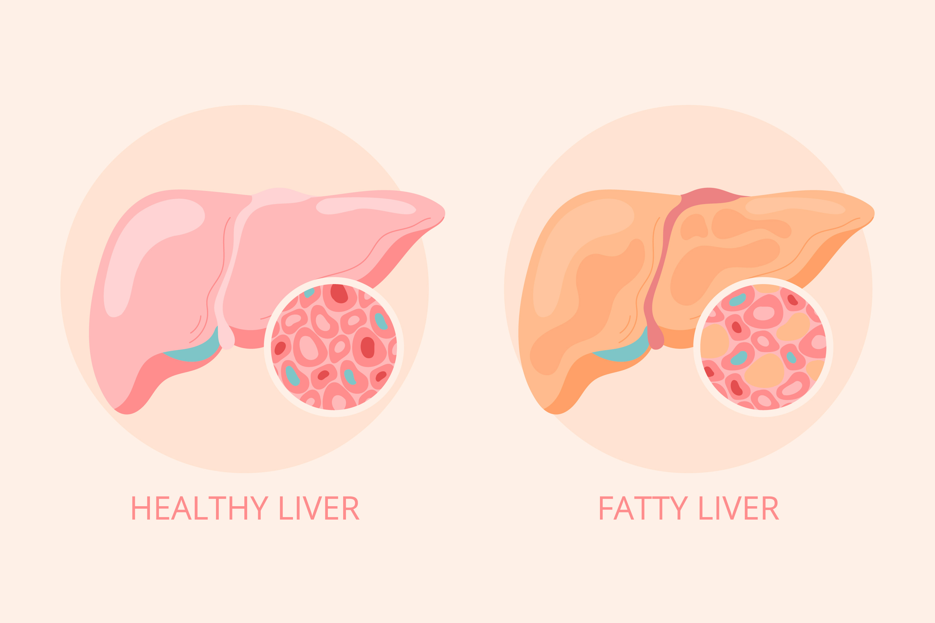 Nonalcoholic fatty liver disease: The Silent Tsunami Threatening Global Health