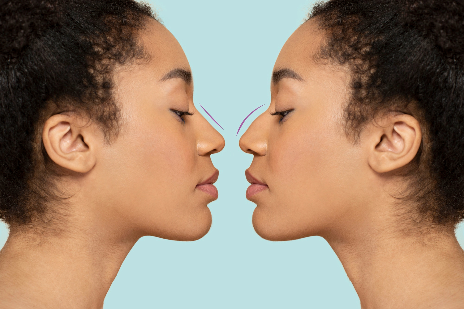 Rhinoplasty: Bridging the Gap Between Aesthetics and Surgery