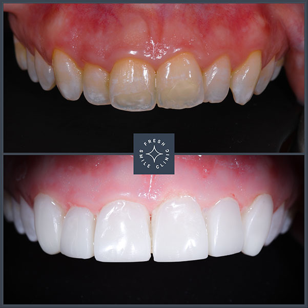 Composite Bonding Fresh Smile Clinic