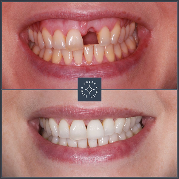 Dental Implants UK Fresh Smile Clinic