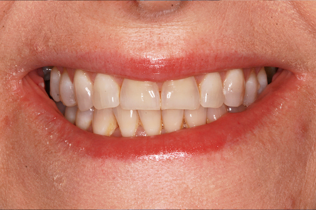 What are Porcelain Veneers? Sydney Smile Doctor