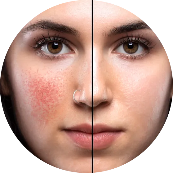 Diode Laser IPL Treatments — Beauty Lab Westmount