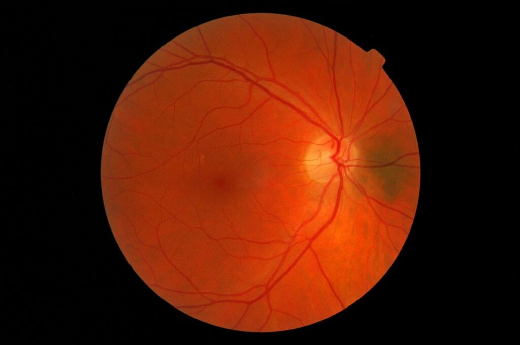 The Retina