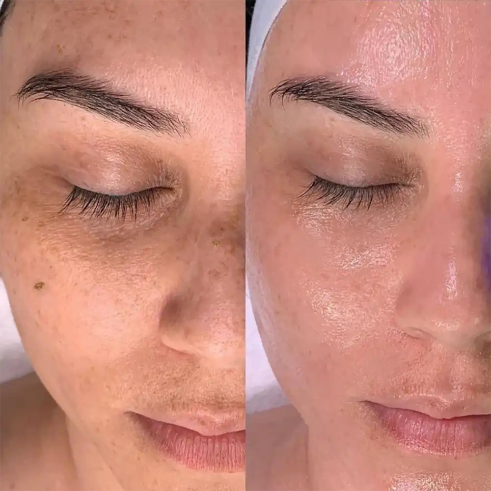 Hydrafacial pores before and after
