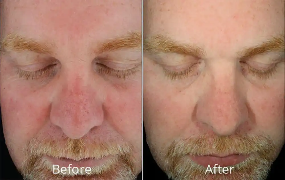 Hydrafacial before and after men