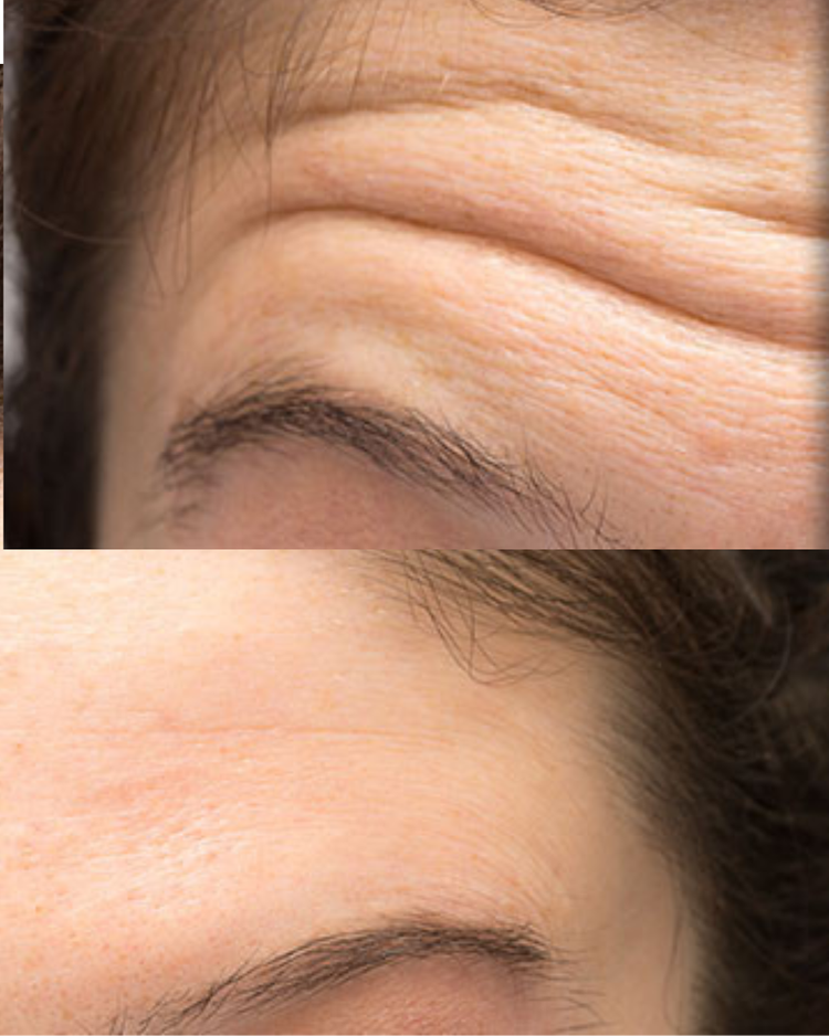 Dermal Fillers Liverpool Model Standards