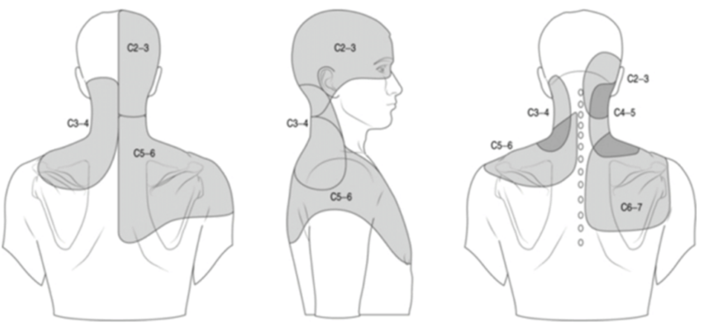 Cervical facet joint pain | Patient information sheets