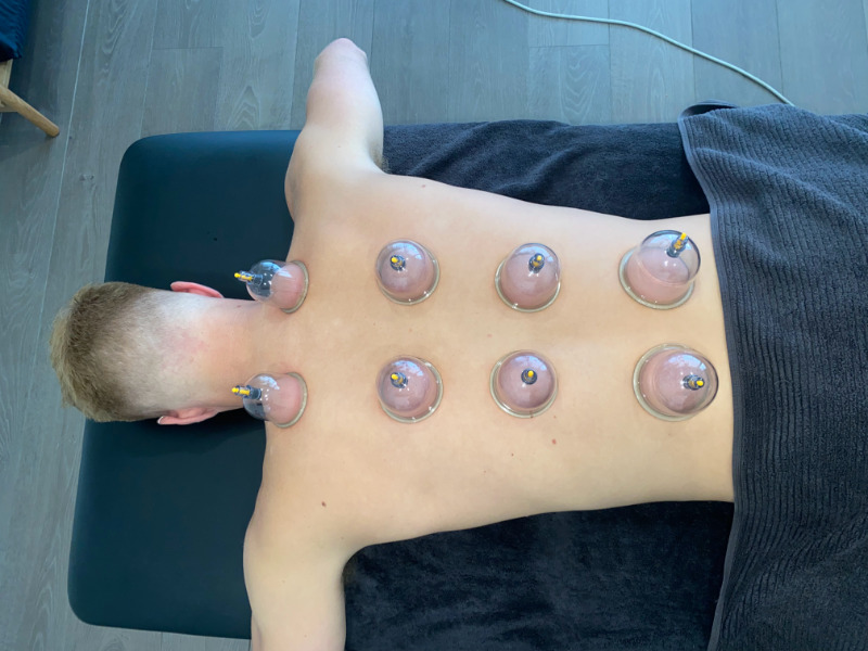 The Enso Clinic What Is Cupping Therapy Back Pain Shoulder Neck 