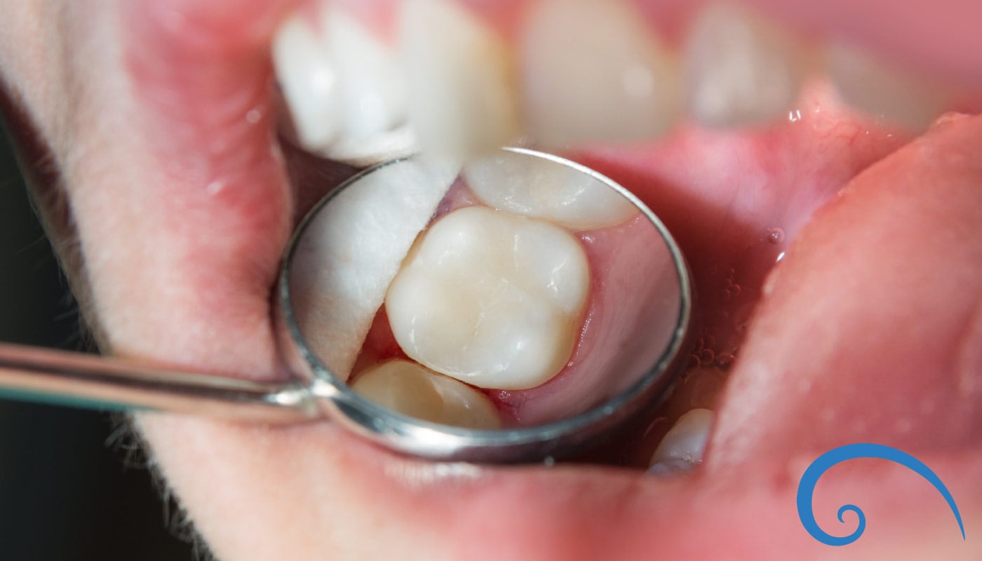 Dental Fillings in Atlanta Atlanta Dental Spa