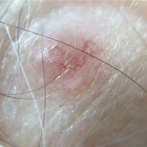 What's a Basal cell carcinoma?