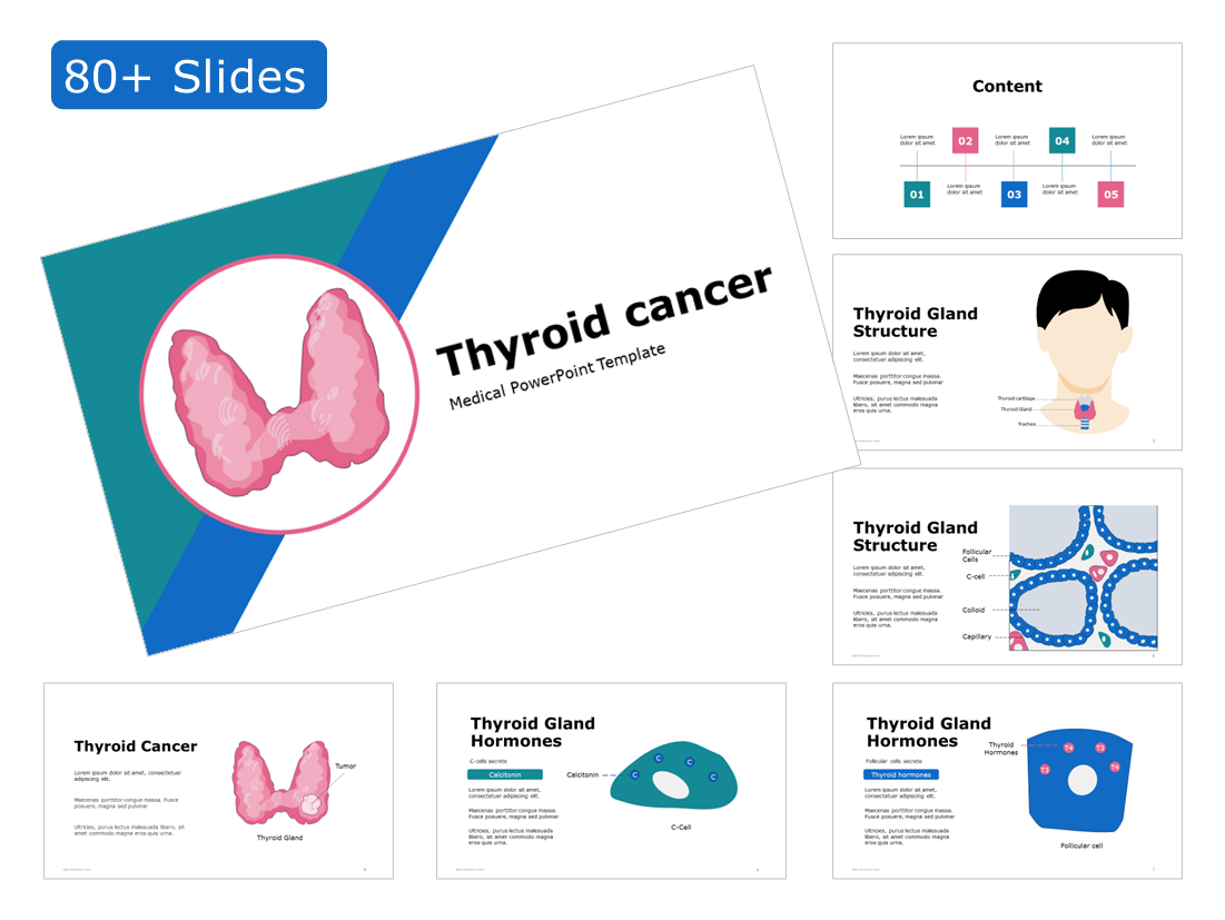Thyroid Cancer PowerPoint Template - RxSlides - The largest online ...