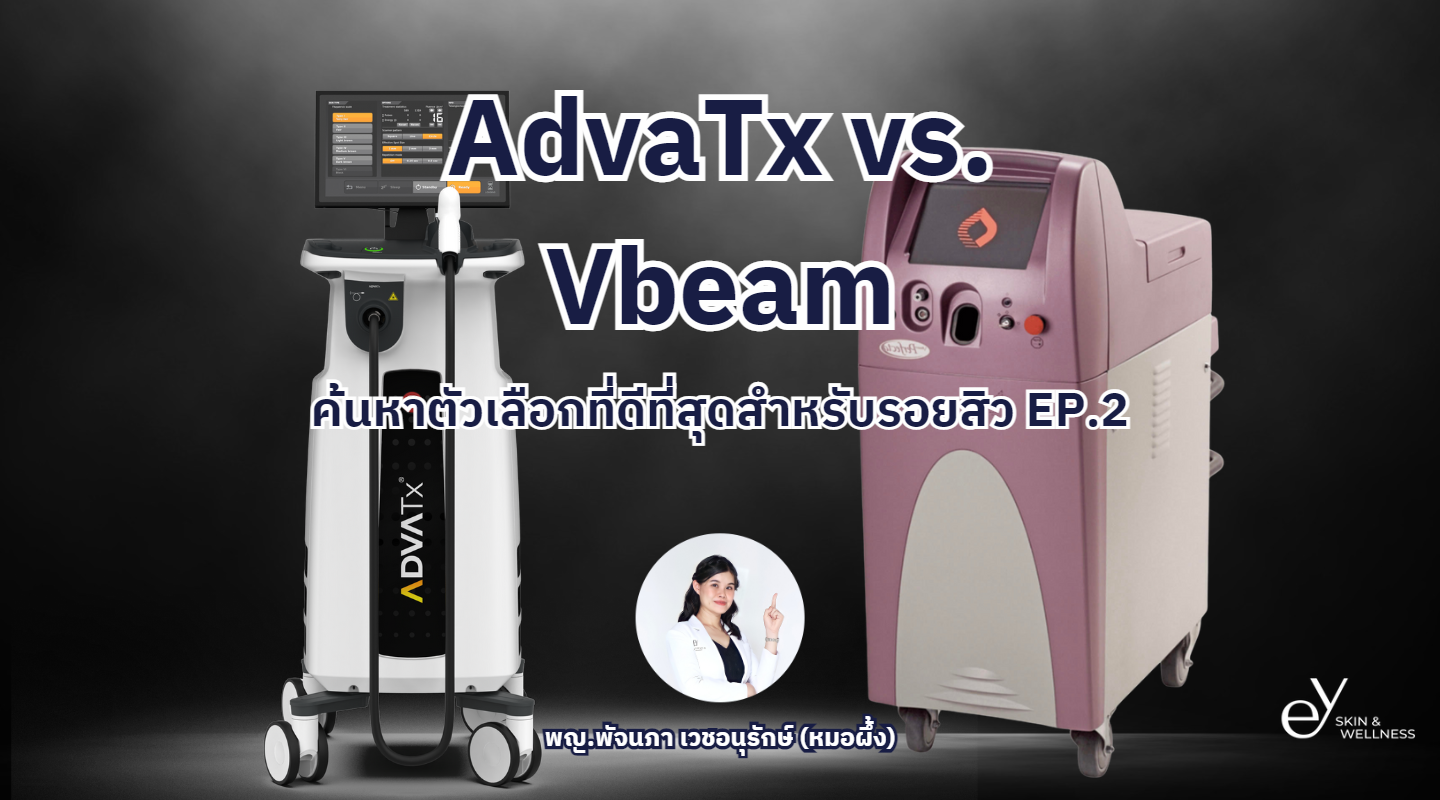 AdvaTx vs. Vbeam สำหรับการรักษาสิว