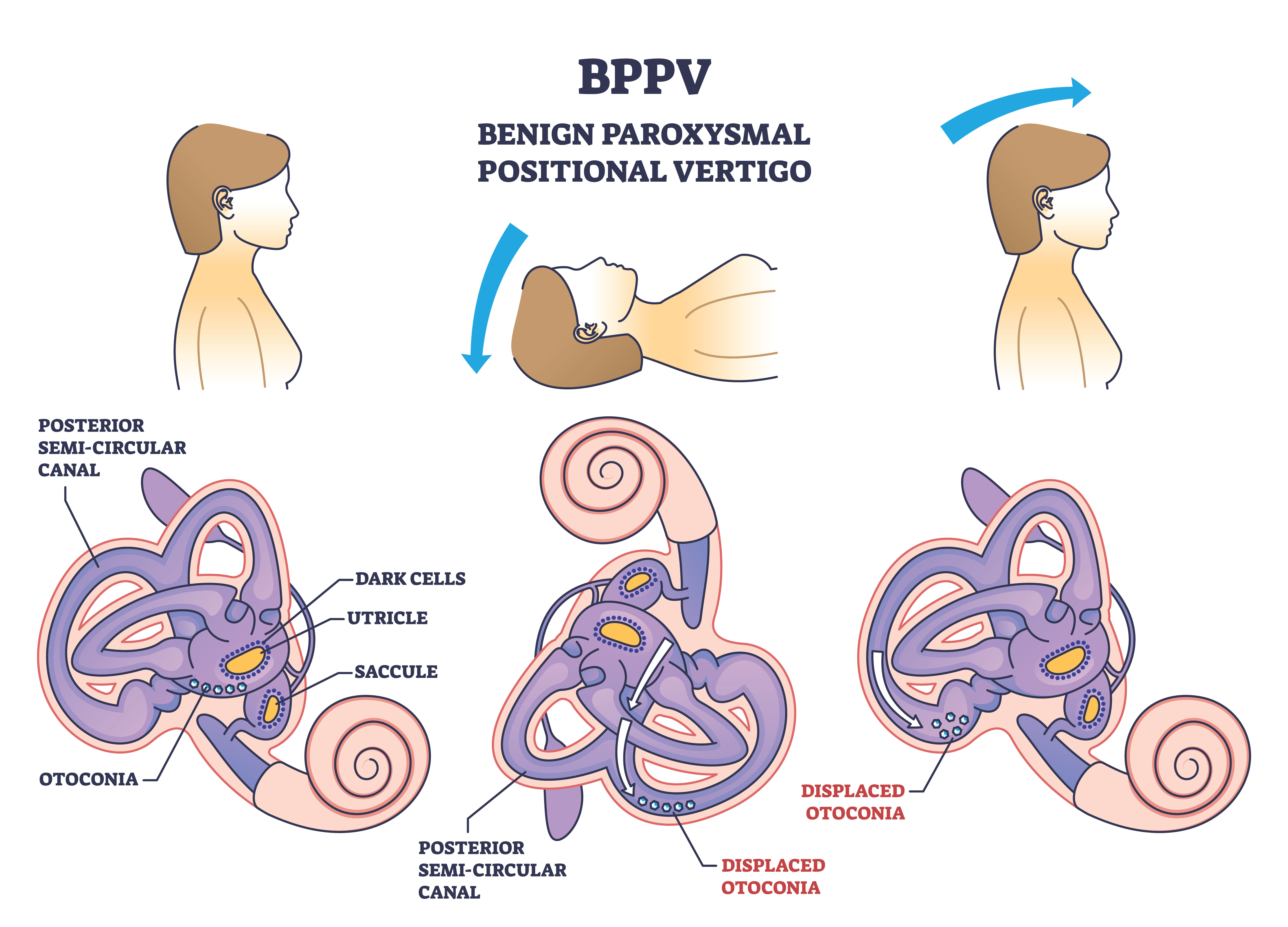 Benign Paroxysmal Positional Vertigo (BPPV)