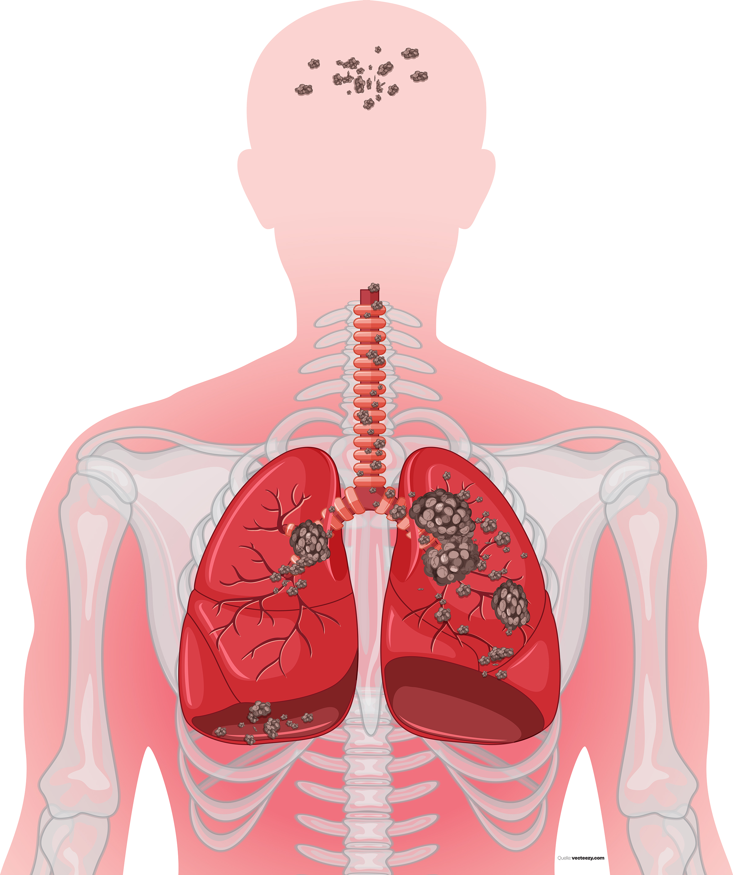 Les différents stades d’évolution du cancer du poumon