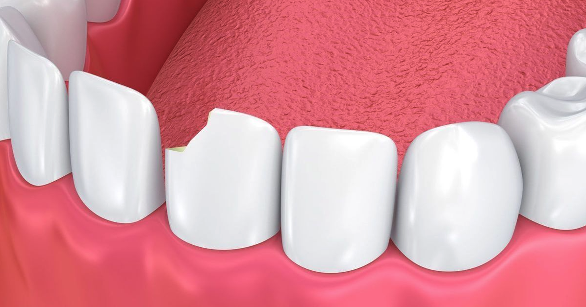 Broken Teeth Treatment in Nashville Bellevue, TN Dentist WPFD