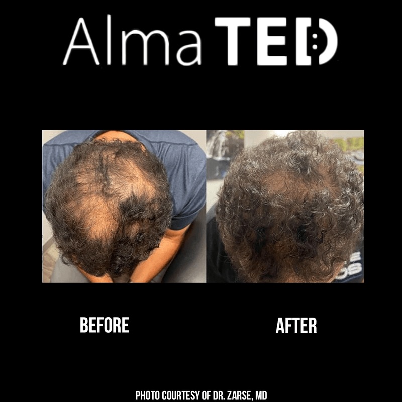 Alma TED Hair Loss Restoration Luminary MD mounjaro-wegovy-side-effects-how-to-cope-what-have-i-experienced