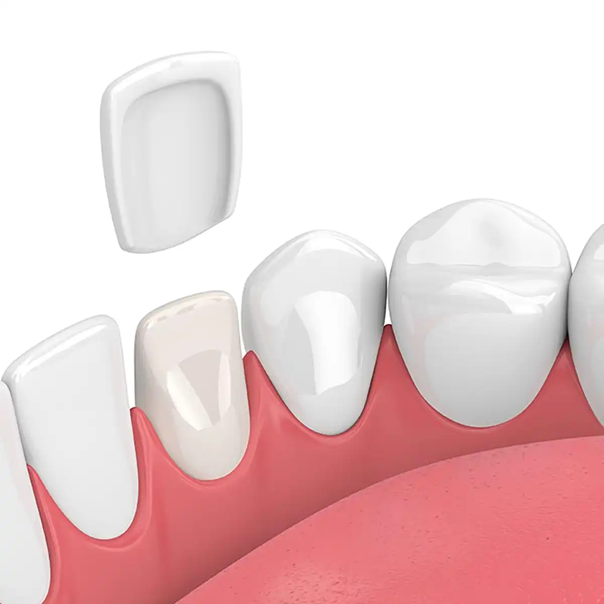 Veneers Foggo Dental Practice Barrhead Dentist Glasgow NHS