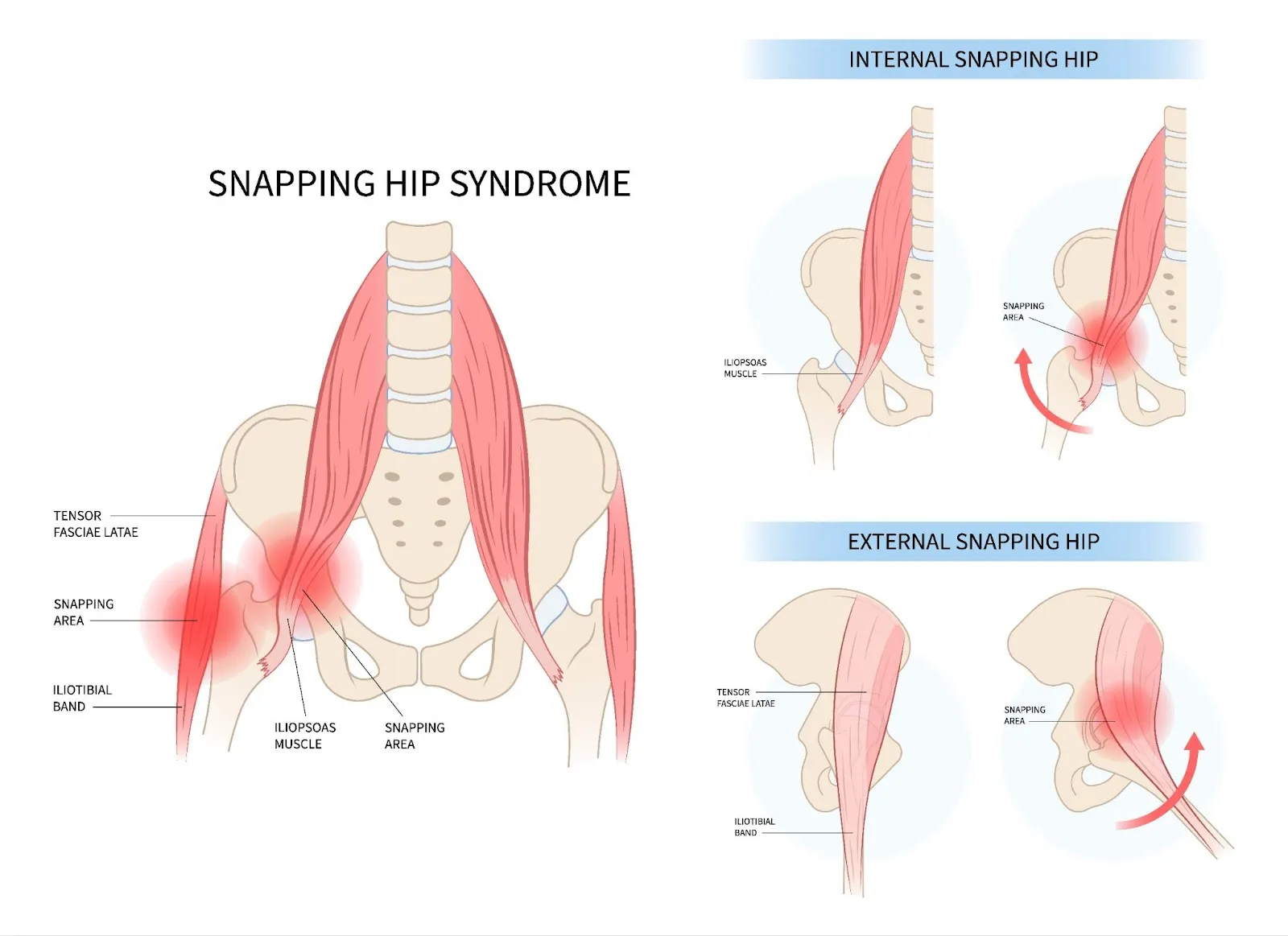 Left Snapping Hip Snapping Hip Syndrome