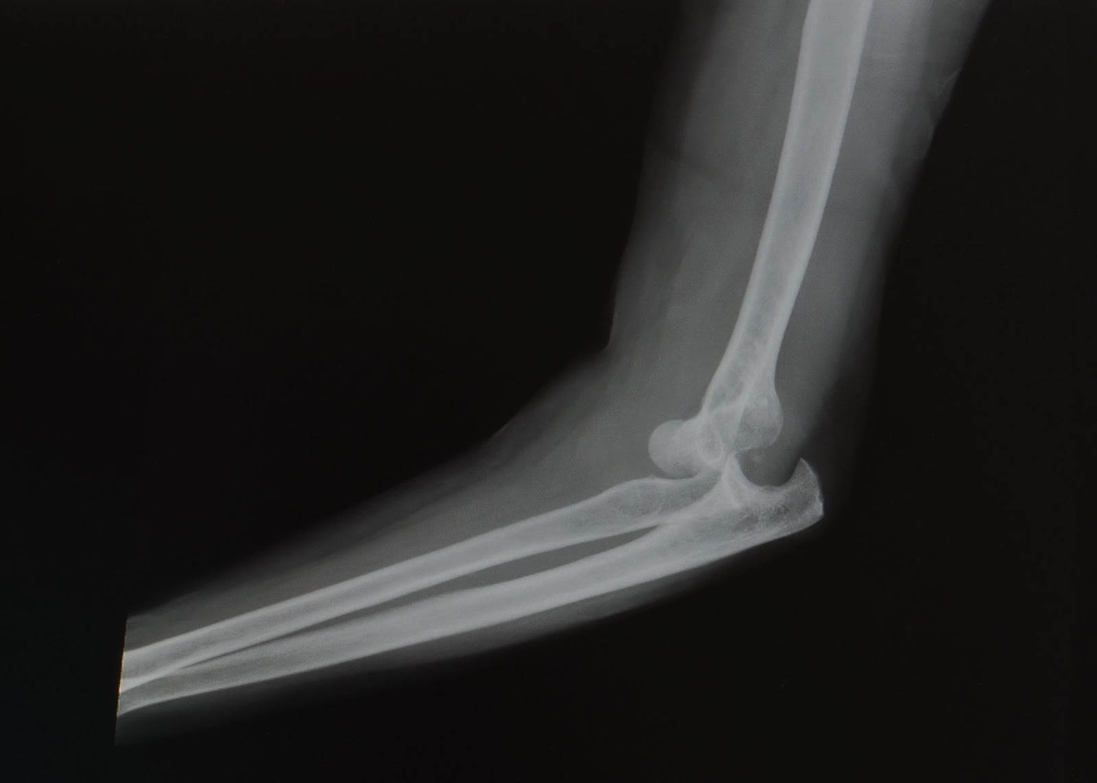 Elbow Dislocation