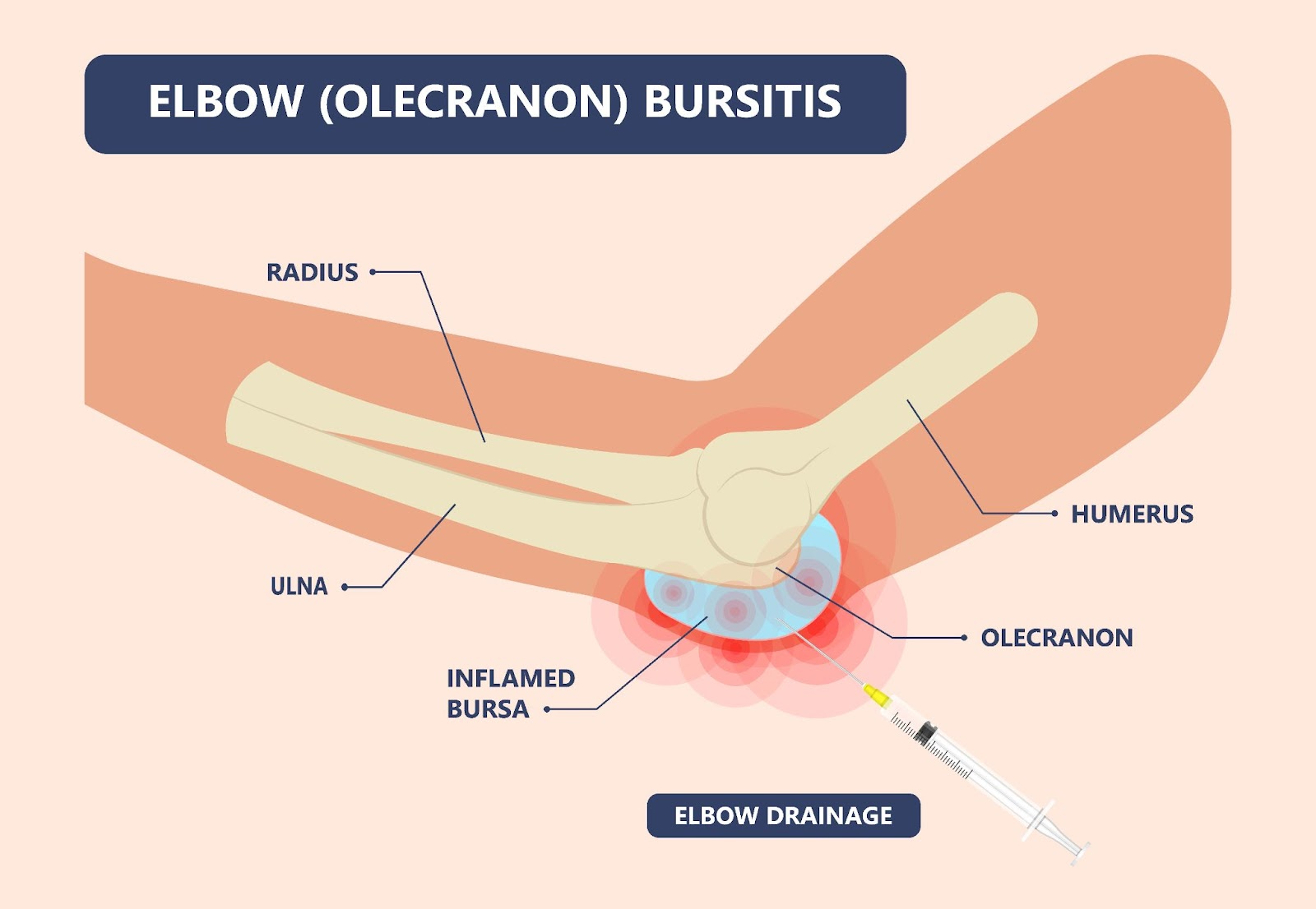 Olecranon Bursitis olecranon-bursitis