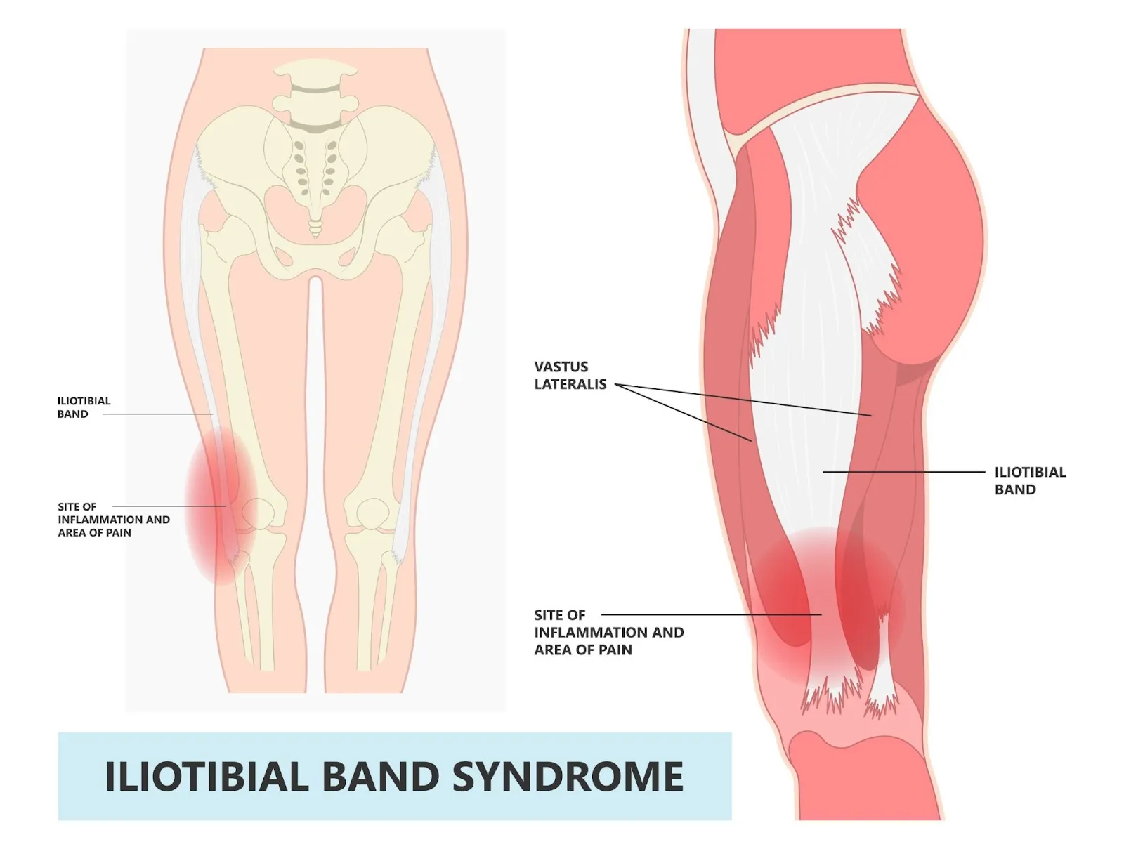 Iliotibial Band Syndrome