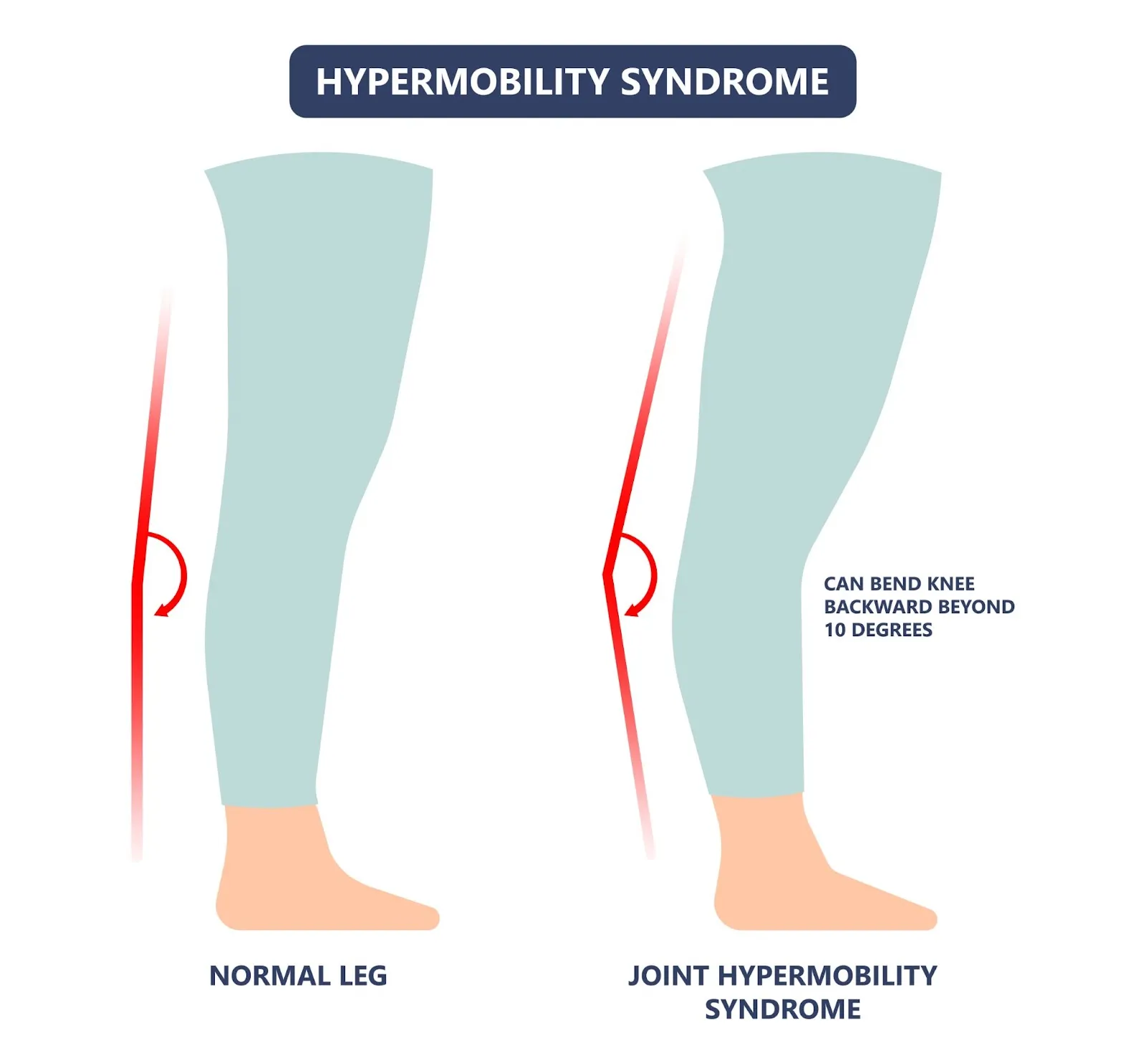 Unstable Kneecap Injury/Subluxing Patella