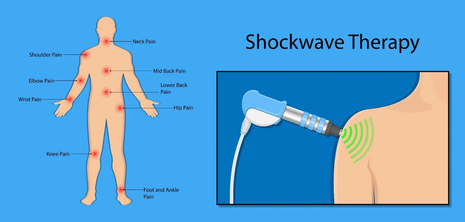 Shockwave Therapy ESWT