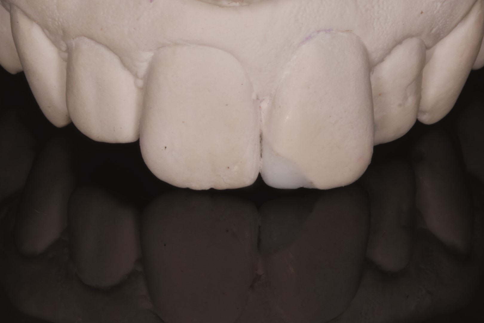 Restauration en composite de l'incisive frontale