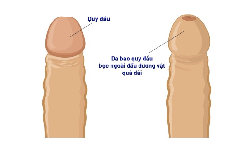 Các dấu hiệu nhận biết bao quy đầu bị dài