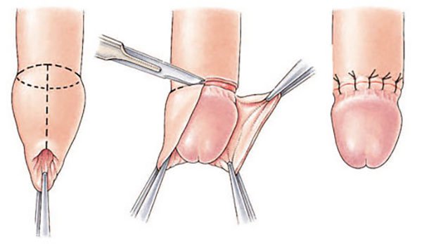 Cắt bao quy đầu được thực hiện ra sao? Cắt bao quy đầu được thực hiện ra sao?