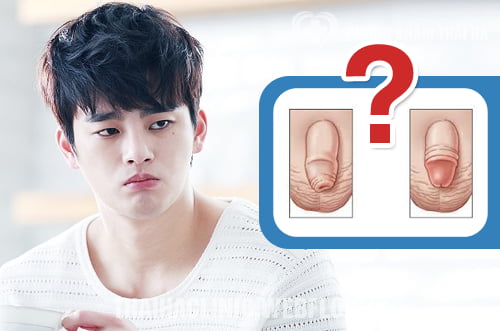 Như thế nào là cắt bao quy đầu ở nam giới Như thế nào là cắt bao quy đầu ở nam giới?