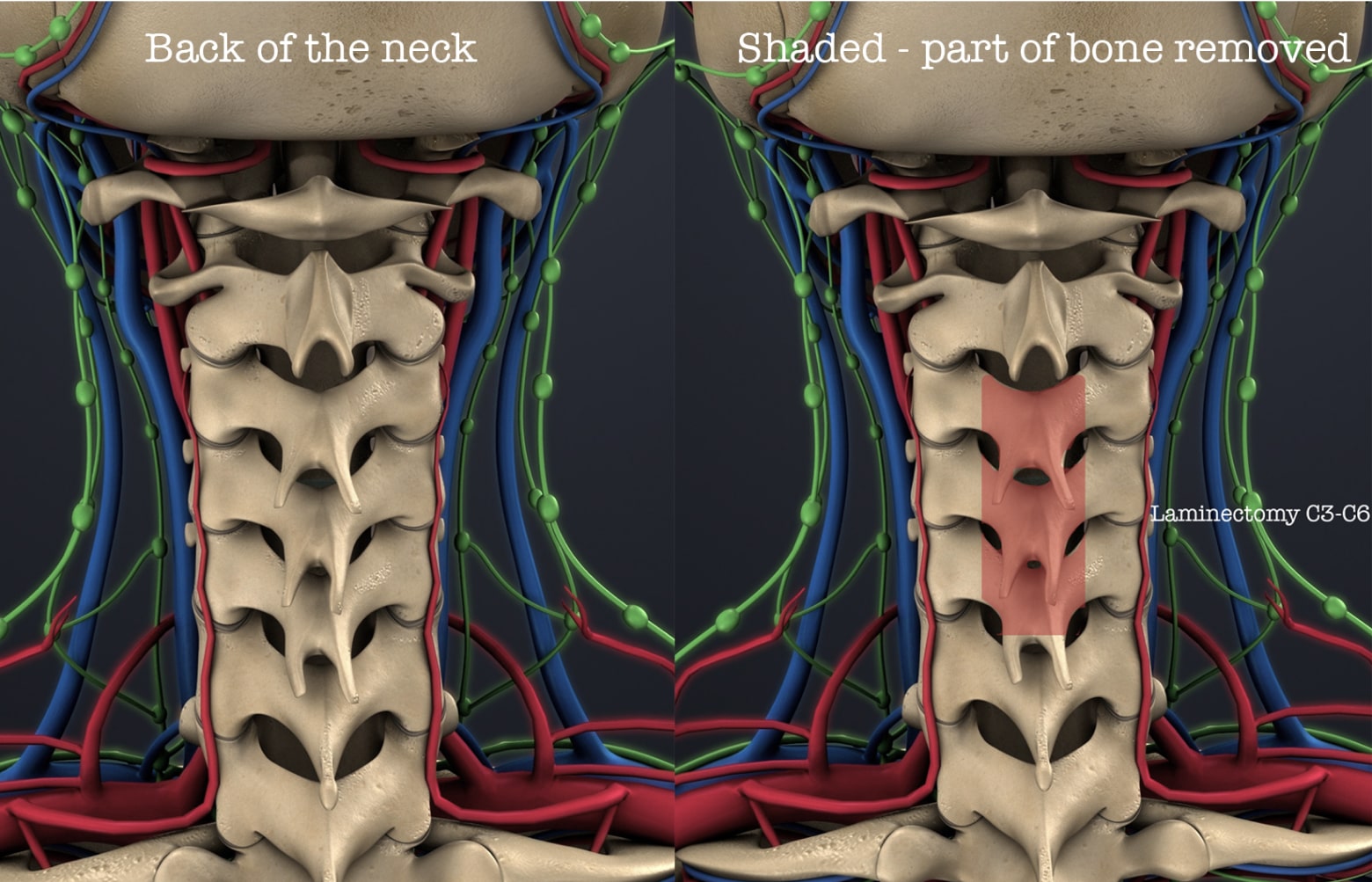 Cervical Laminectomy | Spine Care