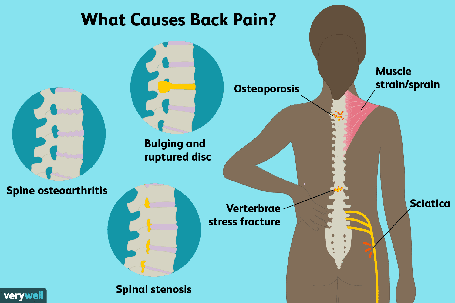 causes of back pain