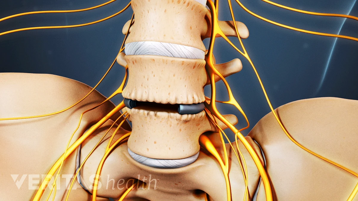 Spinal surgery for back pain