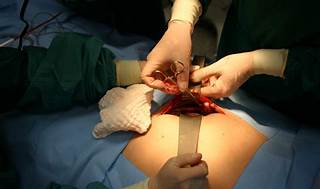 Appendectomy